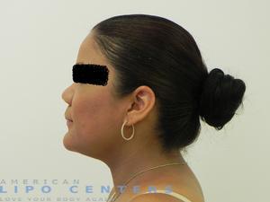 americanlipocenters_100.jpg